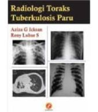 Image of Radiologi Toraks Tuberkulosis Paru